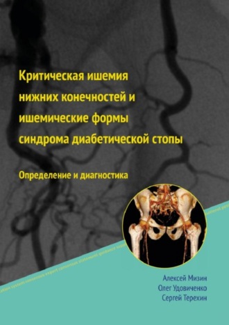 Алексей Мизин, Олег Удовиченко, Сергей Терёхин, Критическая ишемия нижних конечностей и ишемические формы синдрома диабетической стопы