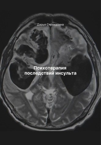 Психотерапия последствий инсульта Дарья Стрекалина, Психотерапия последствий инсульта